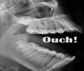 jaw image023